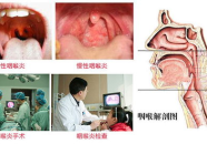 慢性喉炎的症状,声嘶、干燥与不适的全面解读